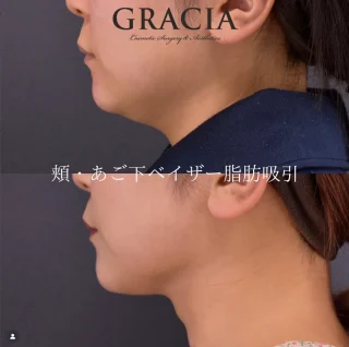 頬あご下ベイザー脂肪吸引