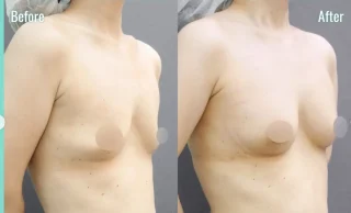 脂肪注入豊胸