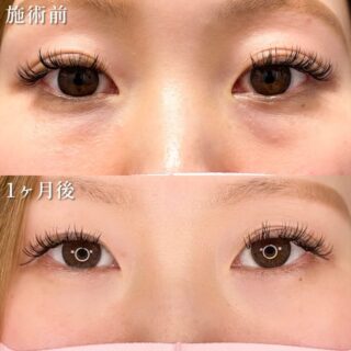 切らない目の下のクマ取り・目の下のたるみ（ふくらみ）取り