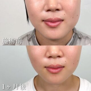小顔美肌再生（リフトアップ）