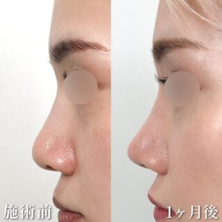 TCB式鼻先尖鋭術（だんご鼻解消）