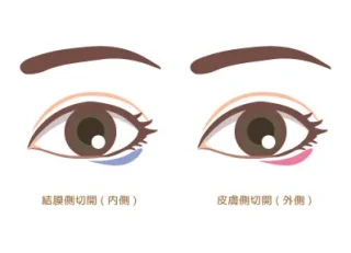 エマクリニック(たれ目形成)