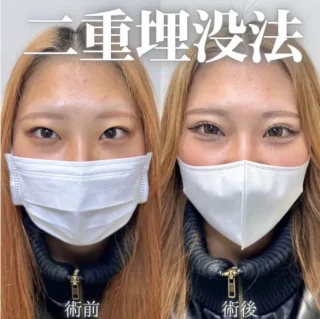 二重埋没方