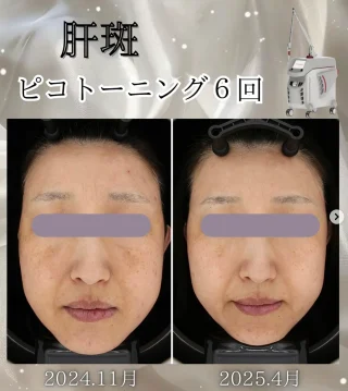 ピコトーニング6回