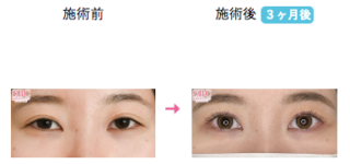 眼瞼下垂＋二重 他
