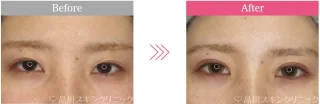 スーパーナチュラル二重術・切開法ロング