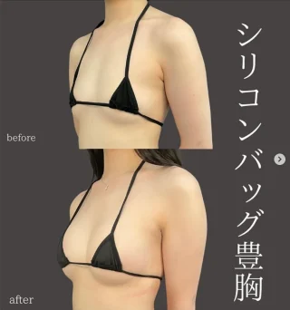 シリコンバッグ豊胸