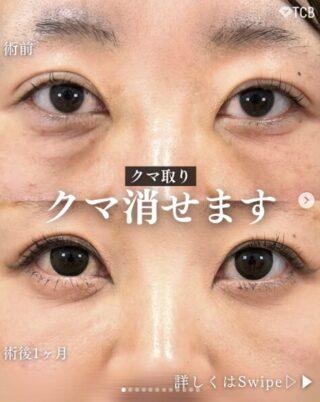 切らない目の下のクマ取り・たるみ取り