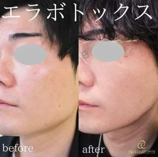 エラボトックス