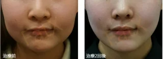 脂肪溶解注射