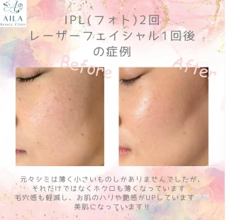 IPL(フォト)治療