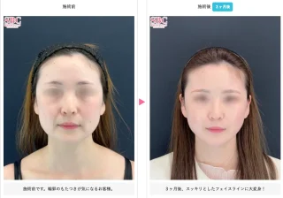 小顔用脂肪吸引注射