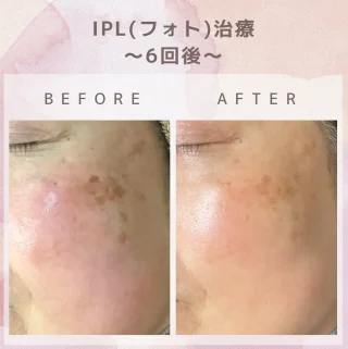 IPL(フォト)治療