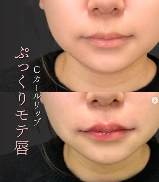  Cカールリップ