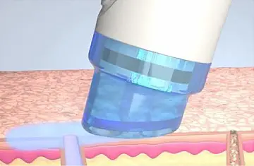 ハイドラフェイシャルステップ1、薬剤で角質を剥がす
