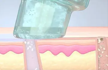 ハイドラフェイシャルステップ2.専用バキュームで汚れを吸引