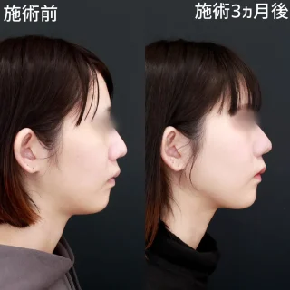 顎下脂肪吸引×糸リフト極