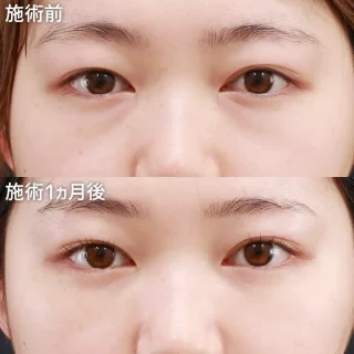 目の下のクマ取り