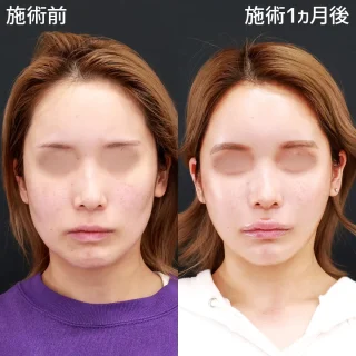 パーフェクトフェイスライン