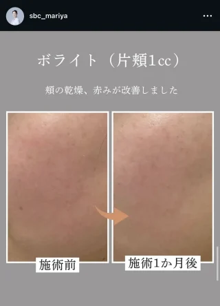 ボライト（ヒアルロン酸）
