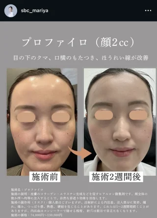 プロファイロ