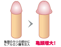 クリスタルメンズクリニック青森院　亀頭増大(強化)治療　施術メニュー画像