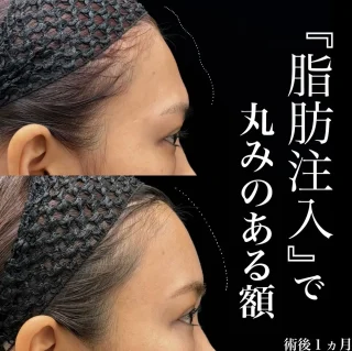 脂肪注入