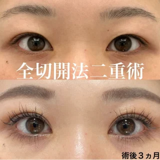 全切開法二重