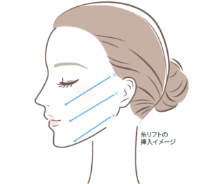 糸リフトイラスト