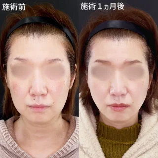 TAC式ツヤ肌コラーゲンリフト®極