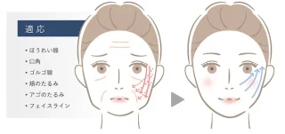 まるやま美容クリニック (糸リフト)