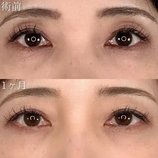 切らない目の下のクマ取り・目の下のたるみ（ふくらみ）取り