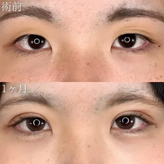 二重埋没法