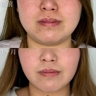 小顔美肌再生（リフトアップ）