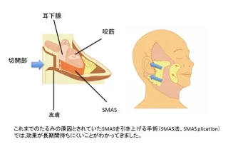 JUN CLINIC フェイスリフト