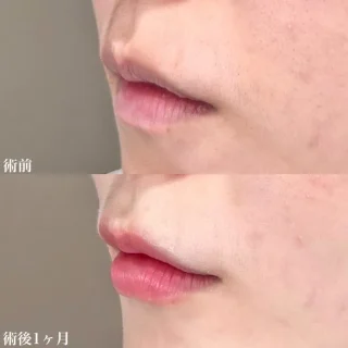 唇のヒアルロン酸注射