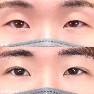 二重埋没法