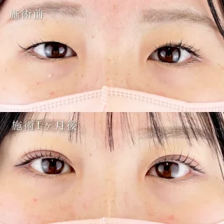 二重埋没法