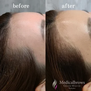 ヘアラインアートメイク(グローバルグランドマスター)