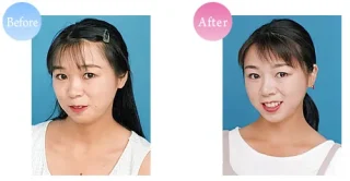 脂肪吸引（顔）