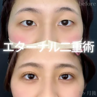 エターナル⼆重術