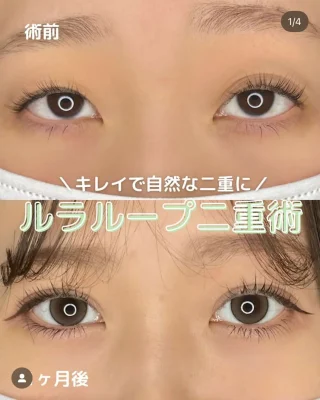 二重術