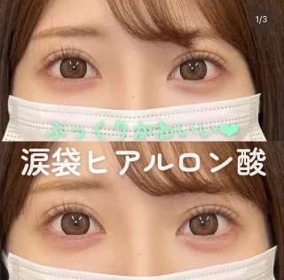 涙袋ヒアルロン酸