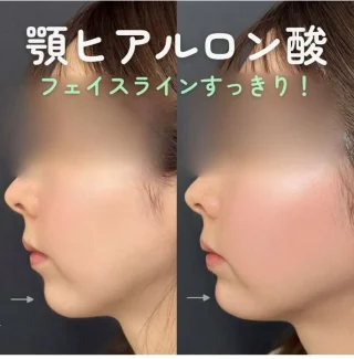 顎ヒアルロン酸