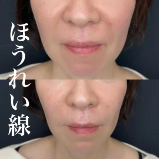 ほうれい線ヒアルロン酸