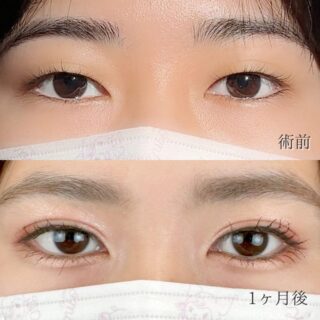 二重埋没法
