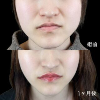 小顔美肌再生（リフトアップ）＆エラのボトックス小顔注射