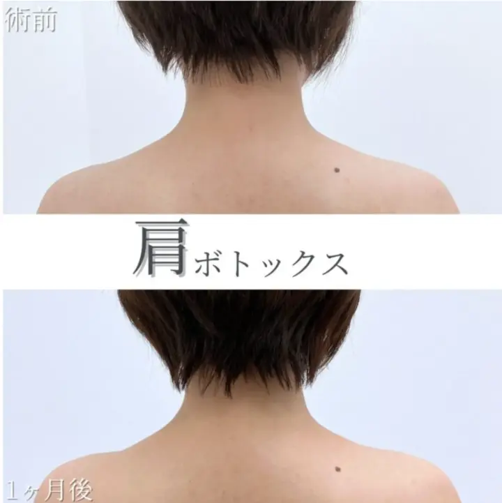 肩ボトックス症例写真｜TCB東京中央美容外科