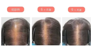 発毛治療