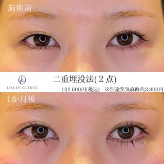 二重埋没法 2点